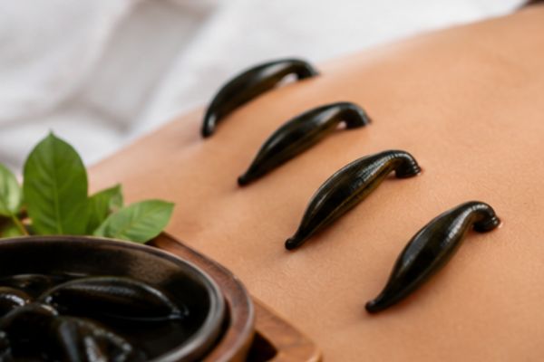 Leech Therapy